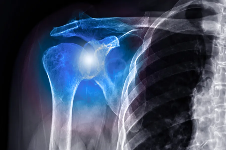 What Is Shoulder Instability